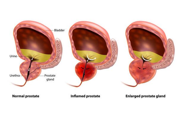 prostatitis adalah keradangan kelenjar prostat