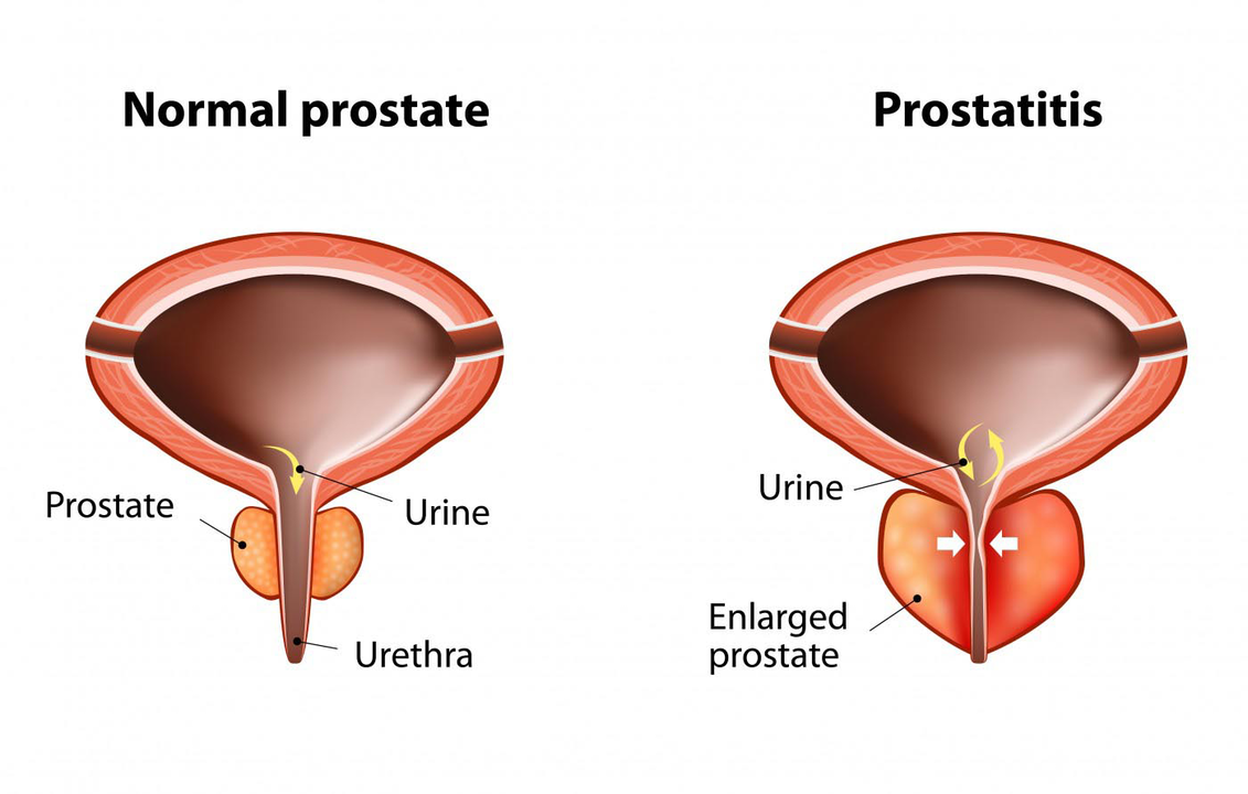 Prostat normal lelaki yang sihat dan keradangan kelenjar prostat dengan prostatitis